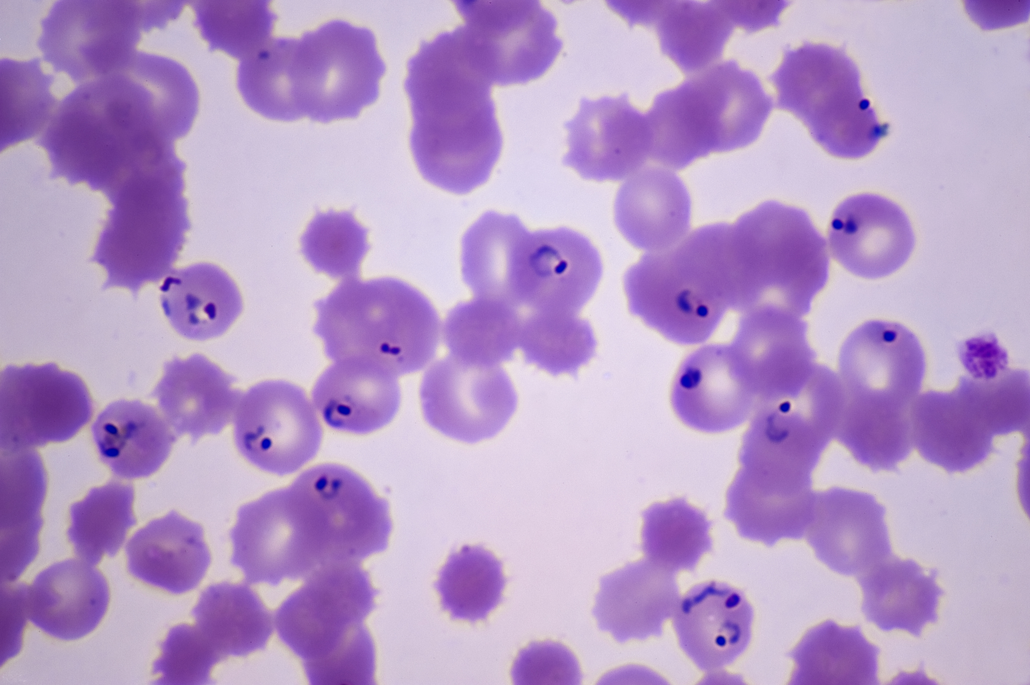 Parasitic Life-Threatening Disease Once Obliterated Has Returned to America