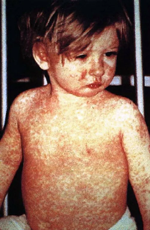 Measles exposures and rising cases across states